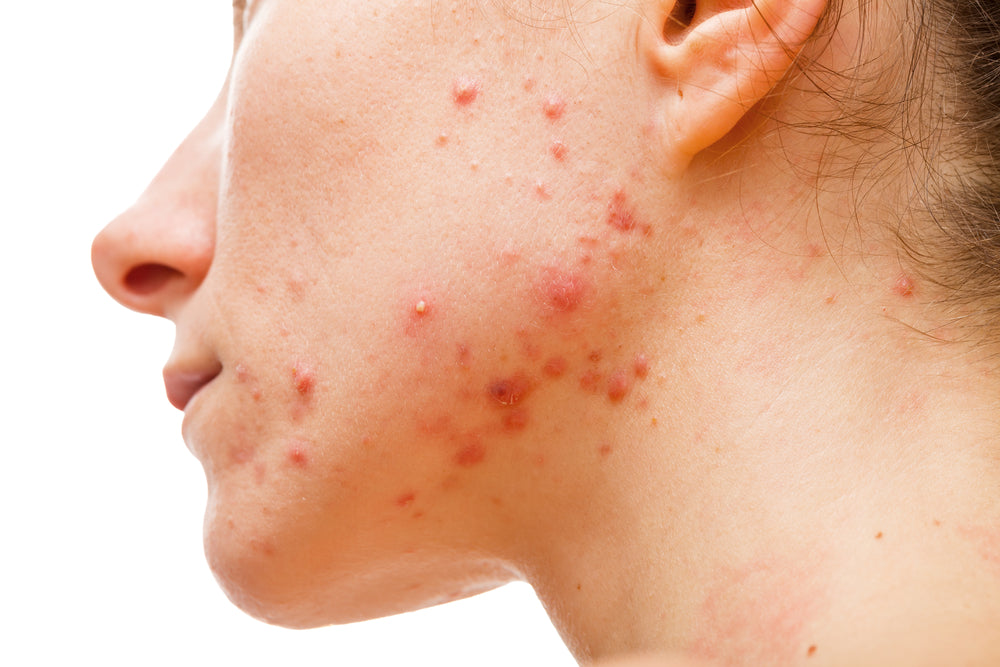 Acne during periods: Everything you should know