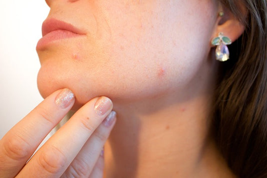 Can pimple patches make your acne disappear?