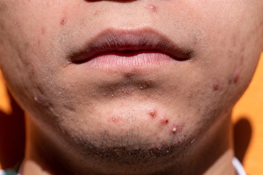 Breaking down Cystic Acne: Symptoms, Causes, and Solutions